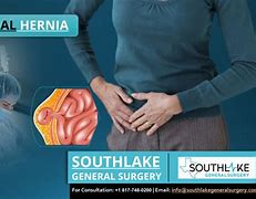 A hernia usually occurs in the abdomen or groin, when one of the organs pushes through the muscle or tissue that contains it. Hernia cure is a natural solution made of plants to preven
