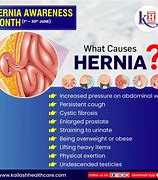 A hernia usually occurs in the abdomen or groin, when one of the organs pushes through the muscle or tissue that contains it. Hernia cure is a natural solution made of plants to preven