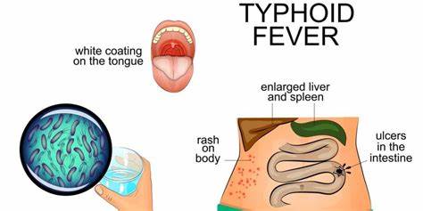 Abat Typhoid is a 100% natural product used to treat Typhoid fever. Typhoid fever is caused by a bacterium Salmonella typhi. If not treated it can cause serious complications and can b