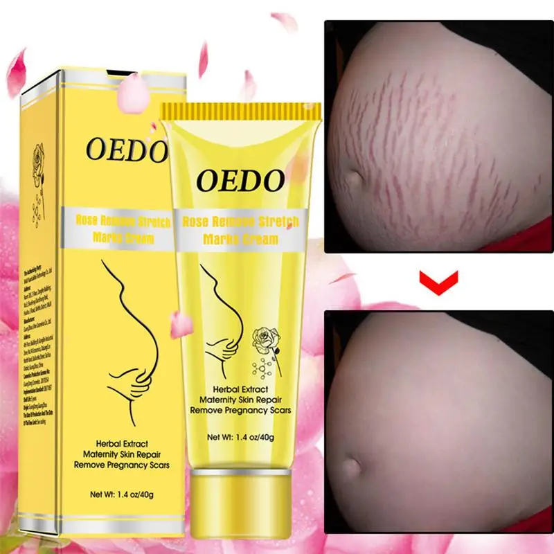 100% Effective Snails Stretch Marks Repair Cream 300g, pregnancy stretch marks cream prevent and remove stretch marks. Snail Stretch Marks Repair cream contains snail extract, nourishe
